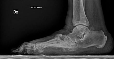 Weight-bearing foot X-ray showing midfoot collapse associated with Charcot neuroarthropathy.