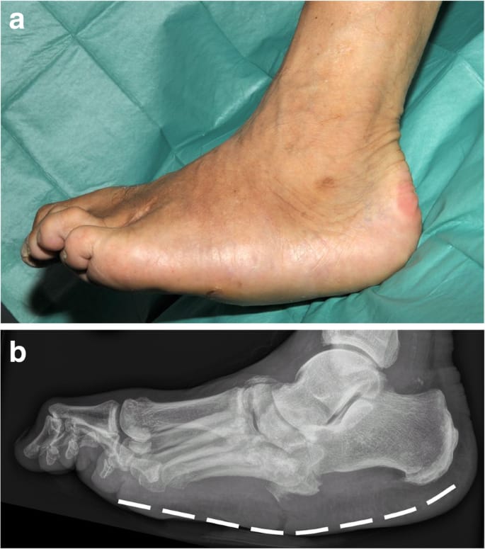 Charcot Foot & Diabetic Foot Reconstruction in Hyderabad
