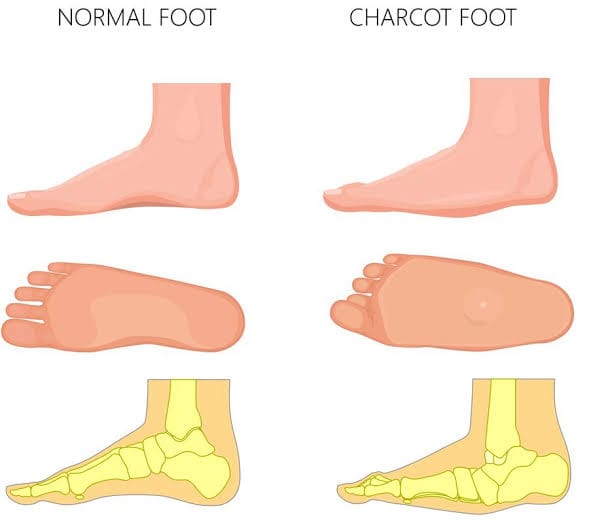 Comparison of a normal foot arch with arch collapse in Charcot foot.