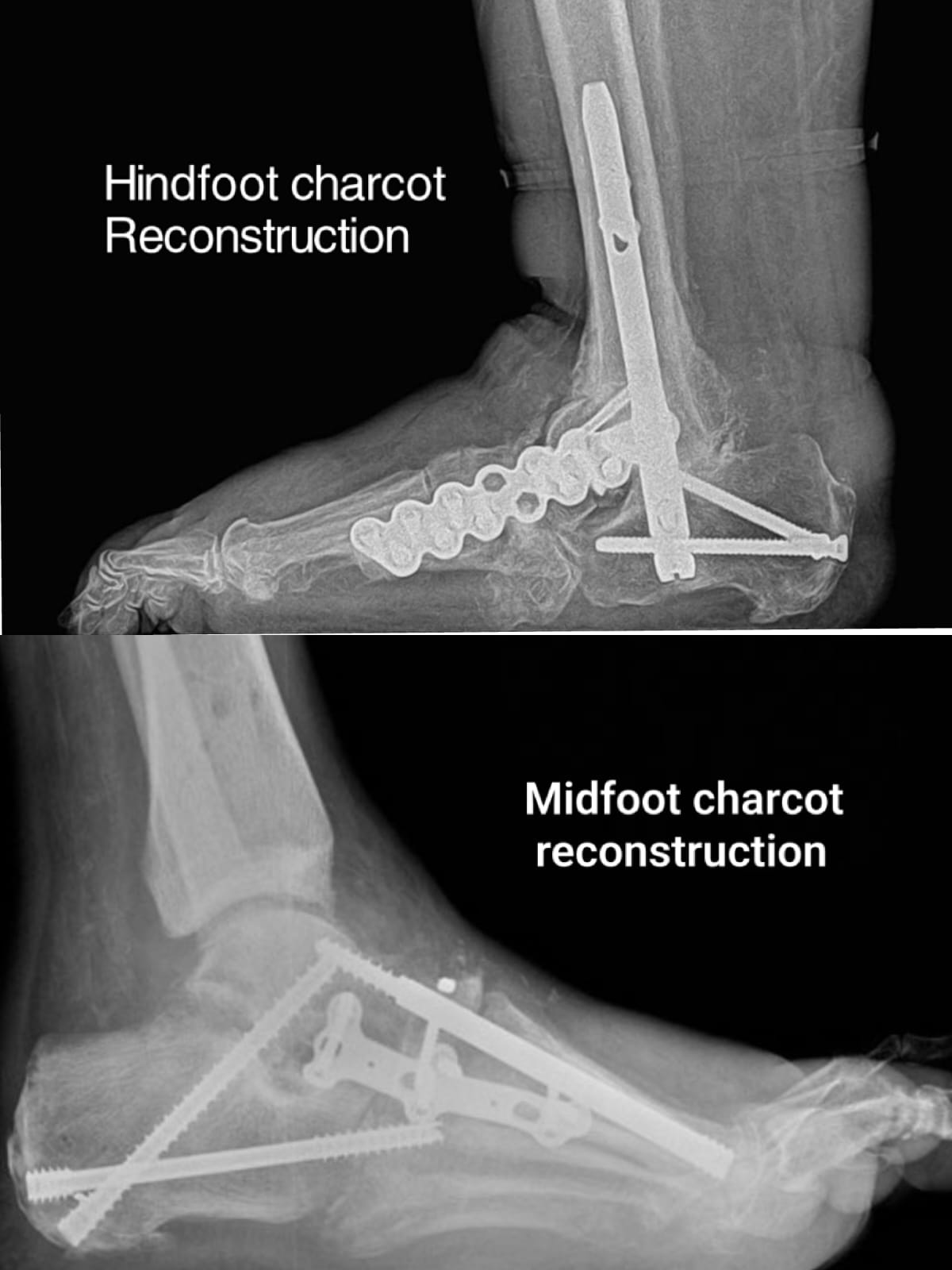 Illustration of bone realignment and internal fixation during Charcot foot reconstruction.